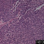 Bladder papillary transitional cell carcinoma