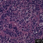 Bladder transitional cell carcinoma