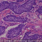 Breast cancer-metastasis-normal Breast infiltrating 03