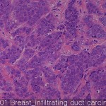 Breast cancer-metastasis-normal Breast infiltrating