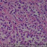 Breast cancer-normal Breast infiltrating 03