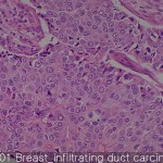 Breast cancer-normal Breast infiltrating