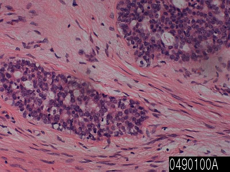 Thesis fibroadenoma breast 07 picture
