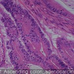 Colon and rectum cancer Ascending colon adenocarcinoma