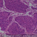 Colon and rectum cancer Transeverse colon adenocarcinoma