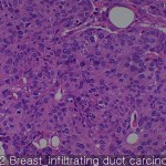 Common cancers Breast infiltrating duct carcinoma 02
