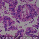 Common cancers Endometrium adenocarcinoma 02