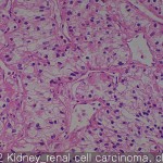 Kidney cancer renal cell 02