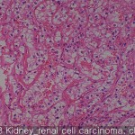 Kidney cancer renal cell 03