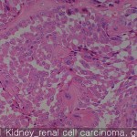 Kidney cancer renal cell