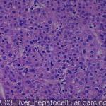 Liver cancer-metastasis-normal hepatocellular carcinoma 03