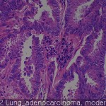 Lung cancer Lung suqamous cell carcinoma 02