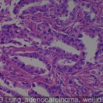 Lung cancer Lung suqamous cell carcinoma 03