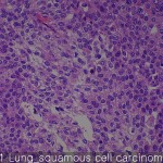 Lung cancer Lung suqamous cell carcinoma
