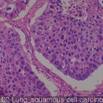 Lung cancer-metastasis-normal Lung squamous cell carcinoma 02