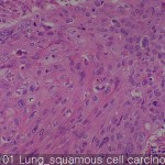 Lung cancer-metastasis-normal Lung squamous cell carcinoma