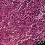 Lung squamous cell carcinoma