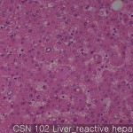 Non-neoplastic liver (matching CS) reactive hepatitus 02
