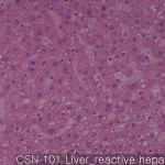Non-neoplastic liver (matching CS) reactive hepatitus