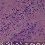 Osteosarcoma Bone femur osteosarcoma