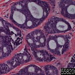 Parotid gland adenoid cystic carcinoma 2