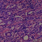Prostate adenocarcinoma Gleason's Score 7