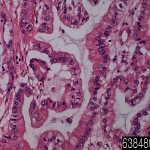 Stomach mucinous adenocarcinoma