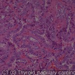 Thyroid cancer-normal papillary carcinoma 03