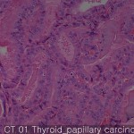 Thyroid cancer-normal papillary carcinoma