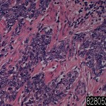 Uterus invasive squamous cell carcinoma