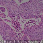 Breast cancer-normal Breast infiltrating 02