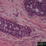 Breast fibroadenoma
