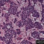Breast infiltrating duct carcinoma