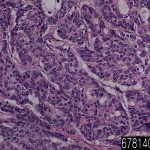 Colon adenocarcinoma mucinous
