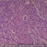 Common cancers Stomach adenocarcinoma 02