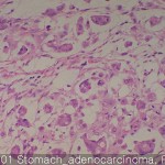 Common cancers Stomach adenocarcinoma
