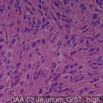 Gastrointestinal stromal tumor jejunum GIST 02