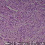 Gastrointestinal stromal tumor jejunum GIST 03
