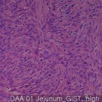 Gastrointestinal stromal tumor jejunum GIST