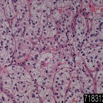 Kidney renal cell carcinoma clear cell type