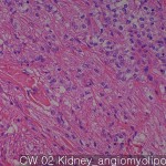 Lipomatous tumors Kidney angiomyolipoma 02