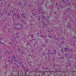 Lipomatous tumors Kidney angiomyolipoma 03
