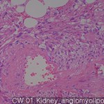 Lipomatous tumors Kidney angiomyolipoma