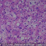 Liver cancer-metastasis-normal hepatocellular carcinoma 02