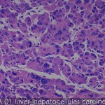 Liver cancer-metastasis-normal hepatocellular carcinoma