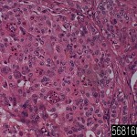 Liver cholangiocarcinoma