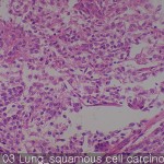 Lung cancer-metastasis-normal Lung squamous cell carcinoma 03