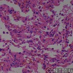 Normal lung (matching CC) Lung