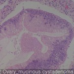 Ovary cancer mucinous cystadenoma
