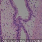 Ovary cancer serous papillary cystadenoma 02